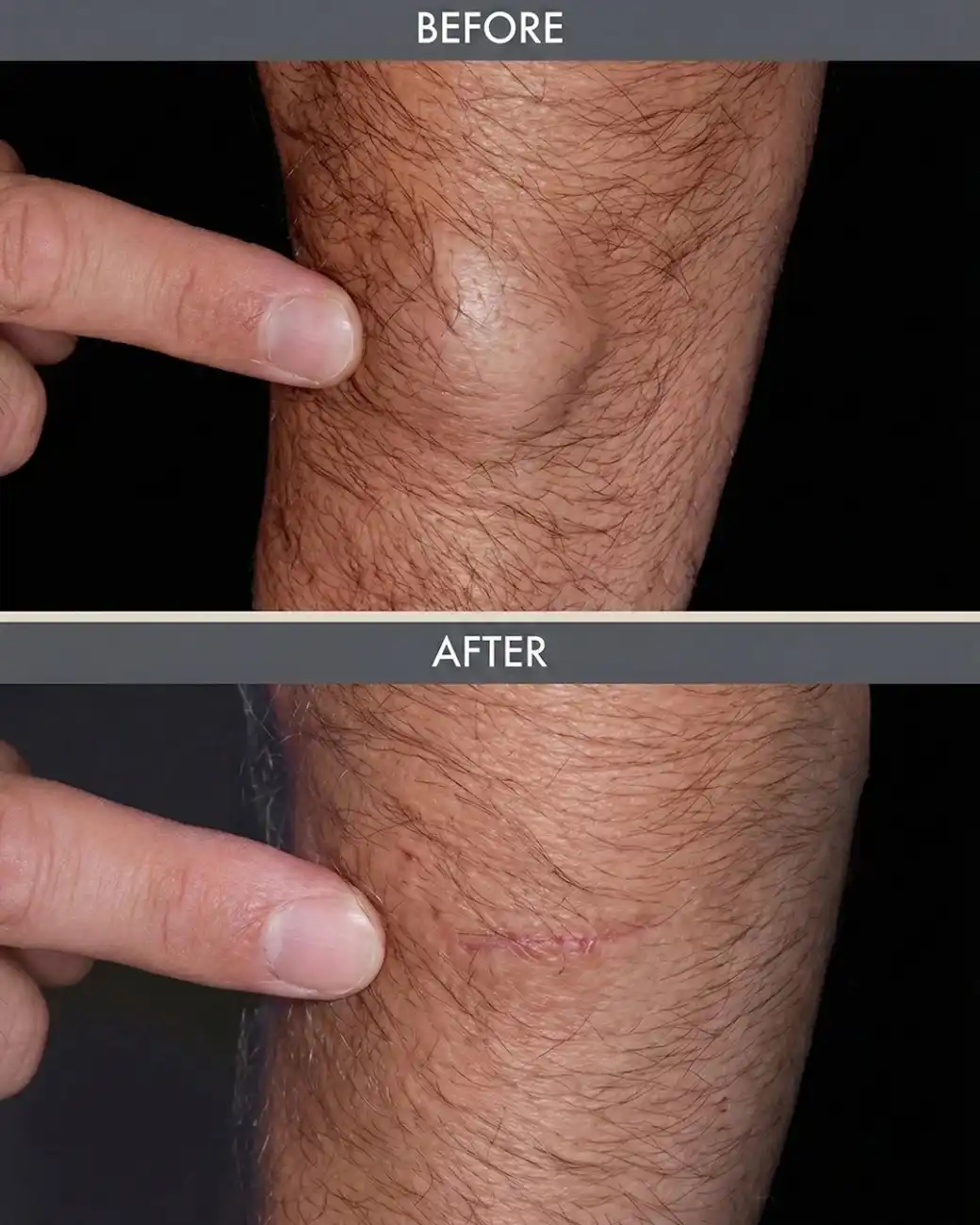 15-Min Sebaceous Cyst & Lipoma Removal in Hyderabad 15-Min Sebaceous Cyst & Lipoma Removal in Hyderabad