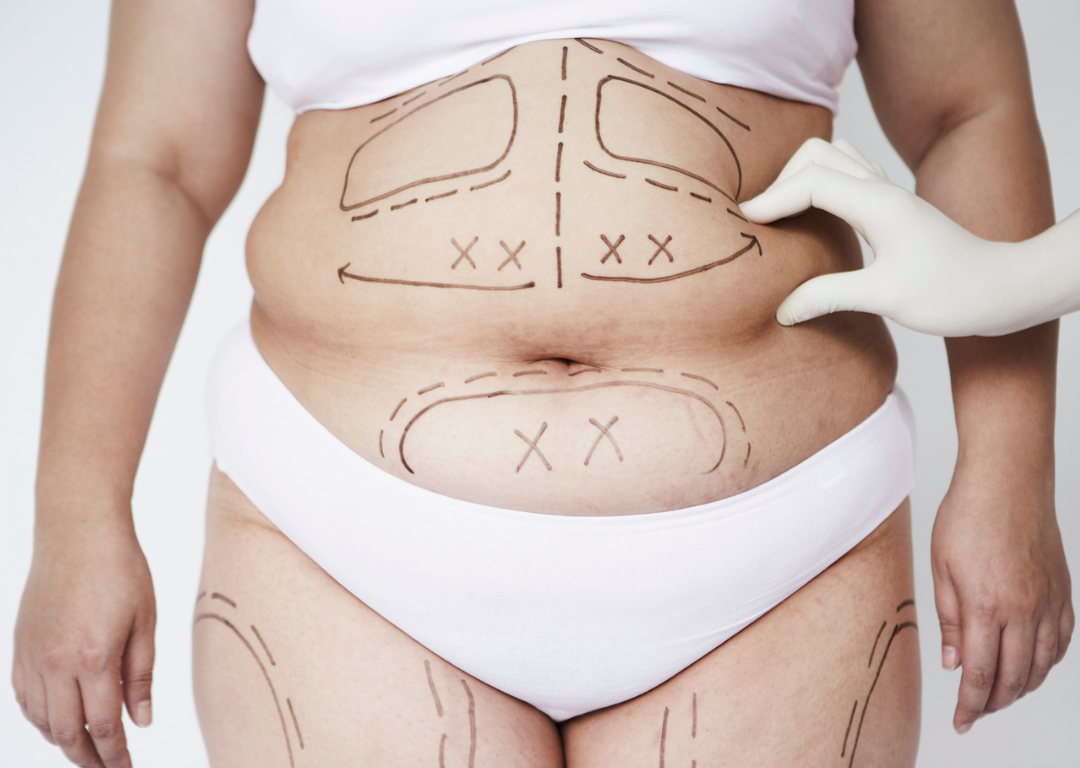 VASER Liposuction and 360 Liposculpture for advanced body contouring and fat reduction in Hyderabad by M.Ch. surgeons at Cosmo Radiance