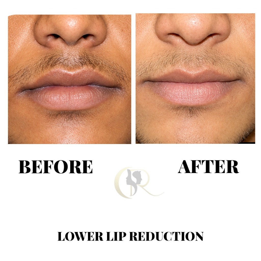 Before and After Lower Lip Reduction Surgery at Cosmo Radiance Hyderabad Before and After Lower Lip Reduction Surgery at Cosmo Radiance Hyderabad