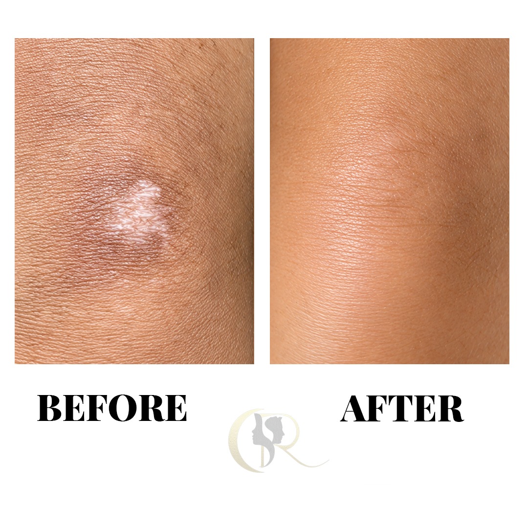 Knee Joint Hypopigmented Scar Camouflage Before and After Knee Joint Hypopigmented Scar Camouflage Before and After