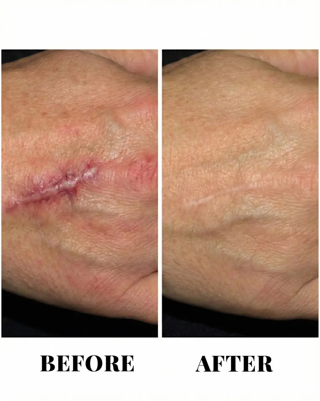 CO2 Fractional Laser & Scar Revision Surgery in Hyderabad CO2 Fractional Laser & Scar Revision Surgery in Hyderabad