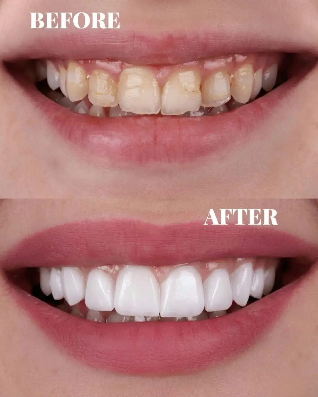 Digital Smile Design (DSD) & Porcelain Veneers in Hyderabad Digital Smile Design (DSD) & Porcelain Veneers in Hyderabad