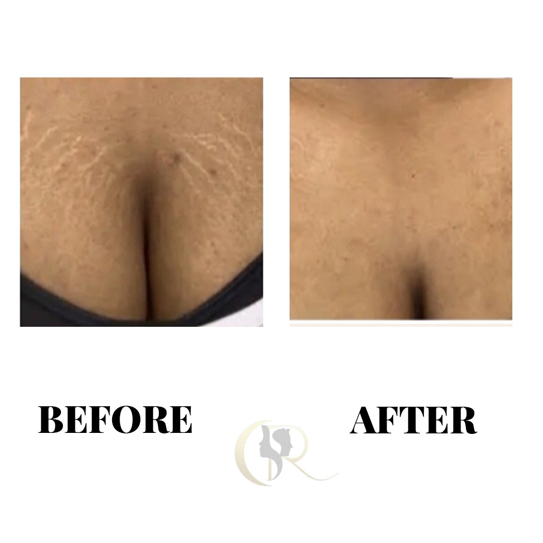 Chest Stretch Marks Striae Camouflage Before and After Chest Stretch Marks Striae Camouflage Before and After