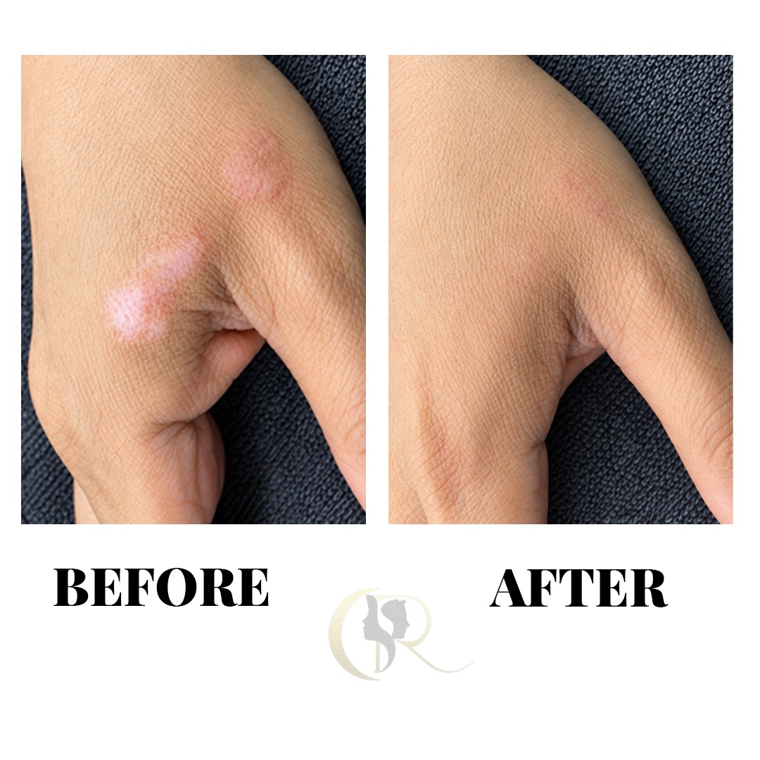 Surgical Scar Hand Burn Camouflage Before and After Surgical Scar Hand Burn Camouflage Before and After