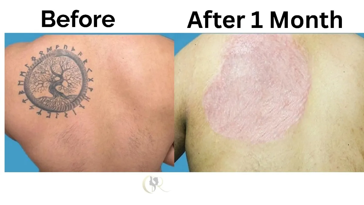 Advanced tattoo removal using picosecond laser and surgical techniques at Cosmo Radiance clinic in Hyderabad, Miyapur