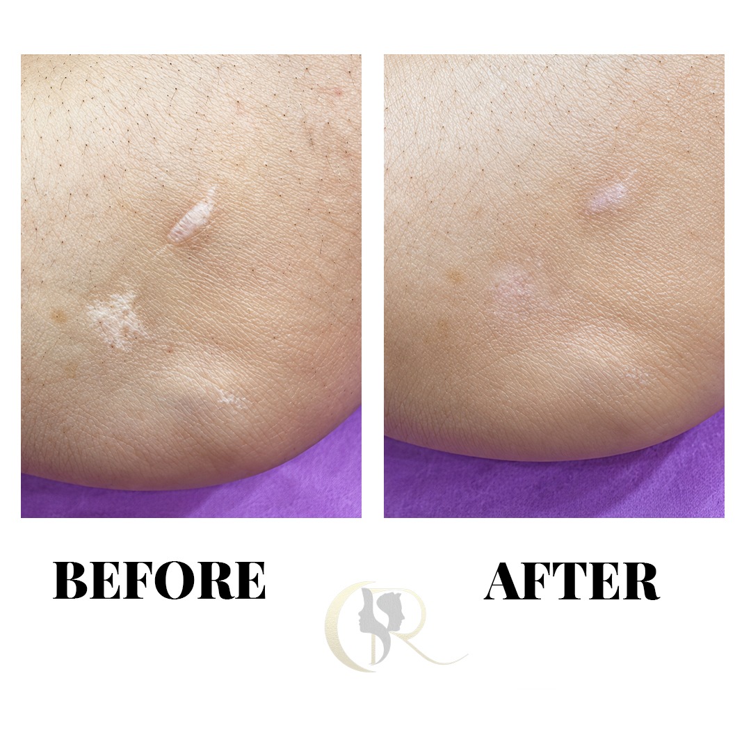 Traumatic Scar Skin Tone Matching Before and After Traumatic Scar Skin Tone Matching Before and After