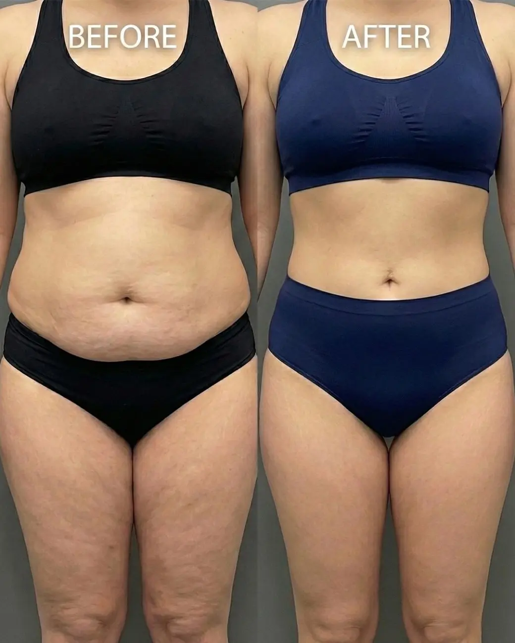 Advanced Tummy Tuck Surgery in Hyderabad | Abdominoplasty Advanced Tummy Tuck Surgery in Hyderabad | Abdominoplasty