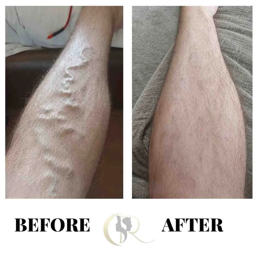 Best Varicose Veins Treatment in Hyderabad | 0% EMI Best Varicose Veins Treatment in Hyderabad | 0% EMI
