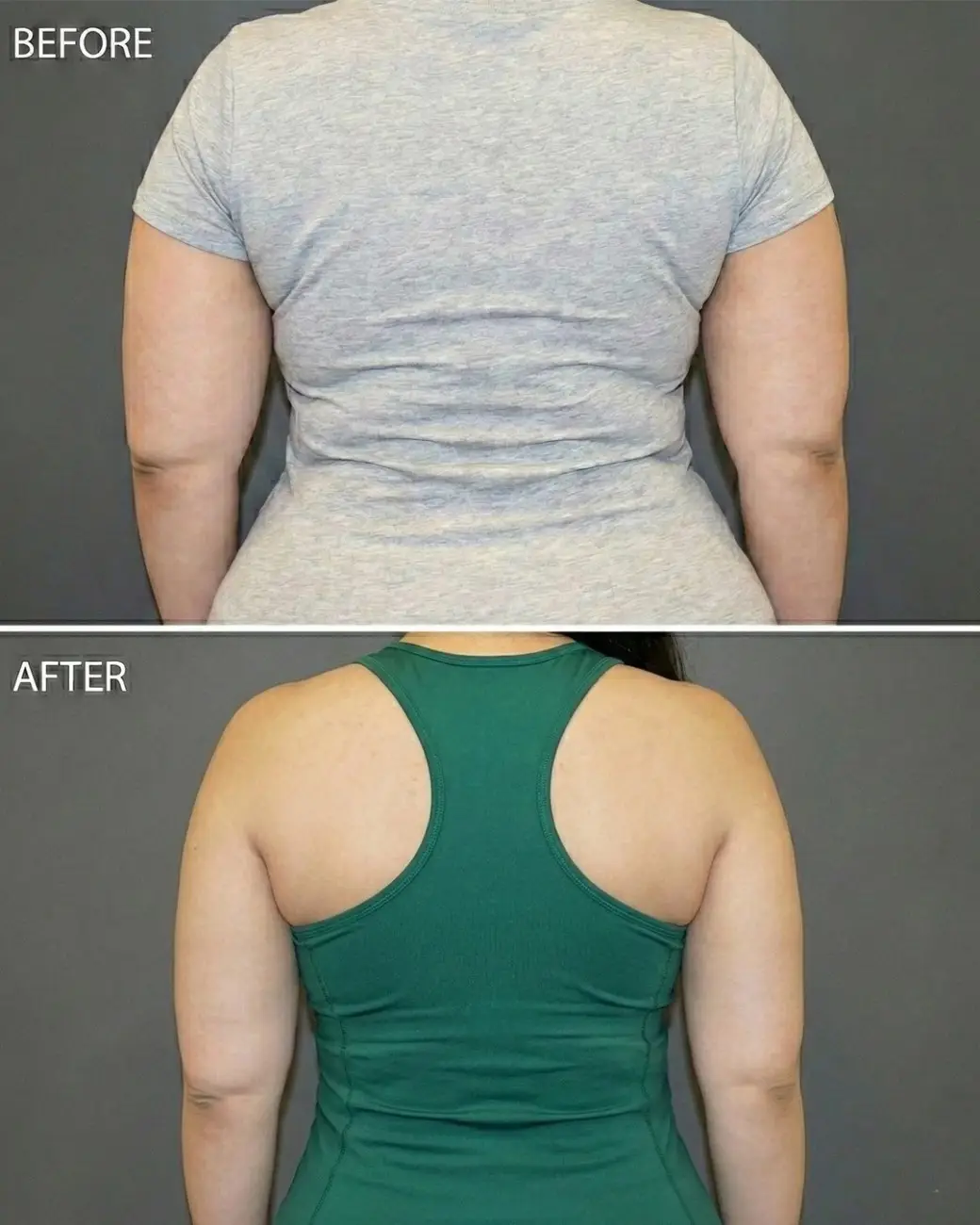 VASER Liposuction in Hyderabad | High-Definition 360 Liposculpture VASER Liposuction in Hyderabad | High-Definition 360 Liposculpture