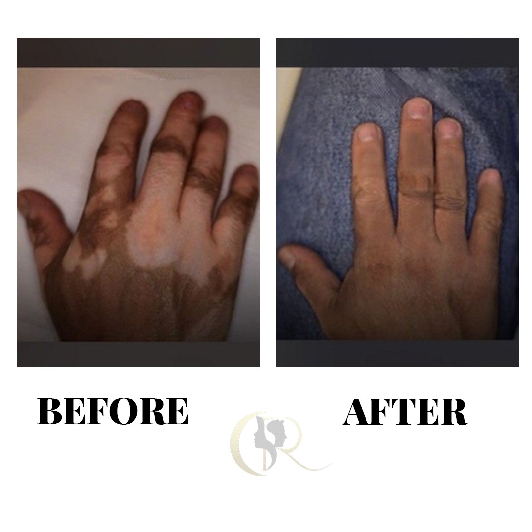 Vitiligo Hand Camouflage Medical Micropigmentation Before and After Vitiligo Hand Camouflage Medical Micropigmentation Before and After