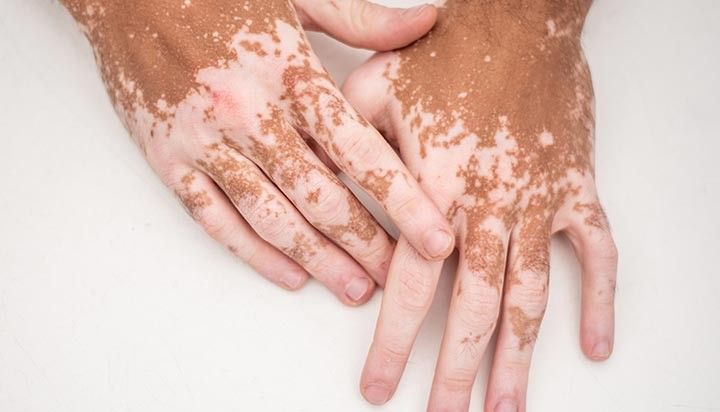 Advanced Autoimmune Skin & Vascular Disease Treatment in Hyderabad Advanced Autoimmune Skin & Vascular Disease Treatment in Hyderabad